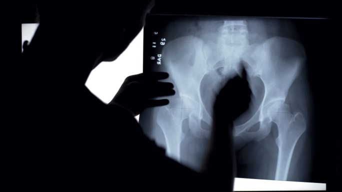 医生分析骨盆的x光片