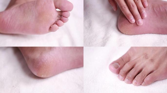 脚底脱皮黑斑干纹脚气真菌感染护理