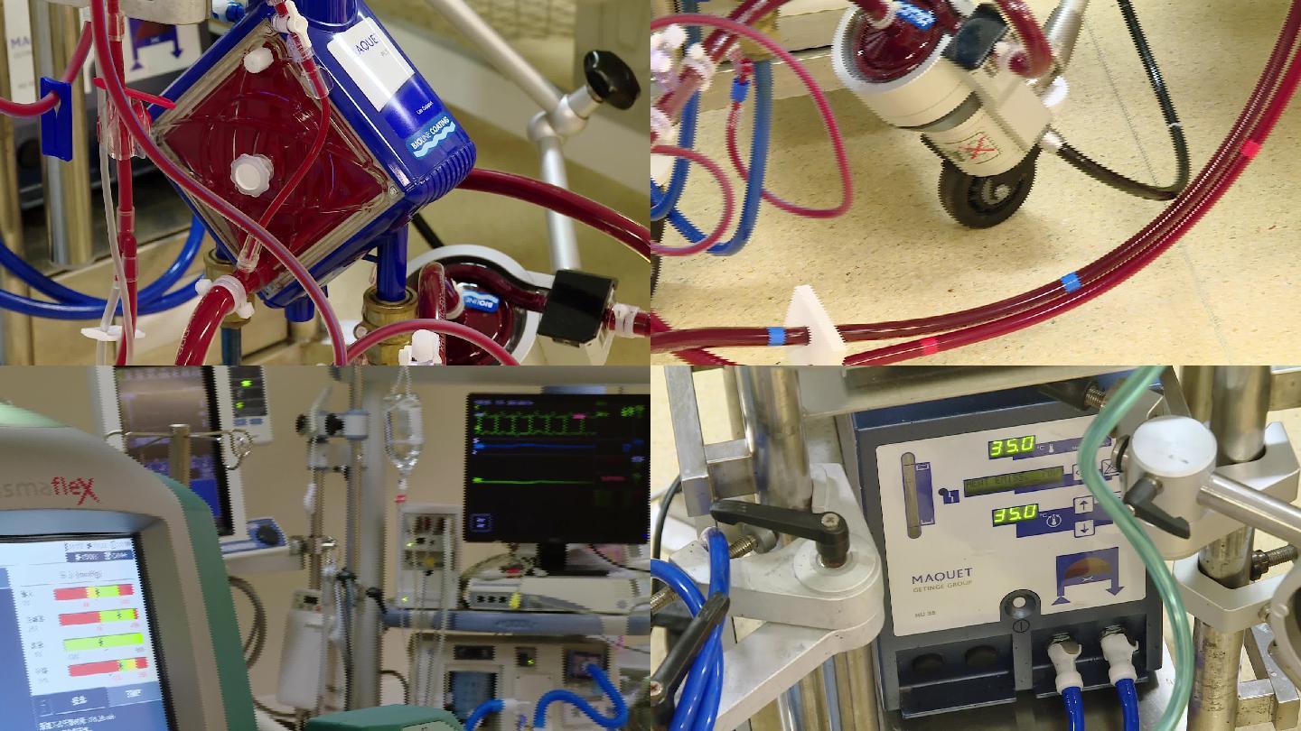 医院ICU人工心肺ECMO