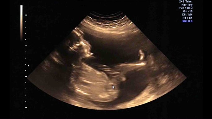 婴儿或胎儿21周时的超声波检查