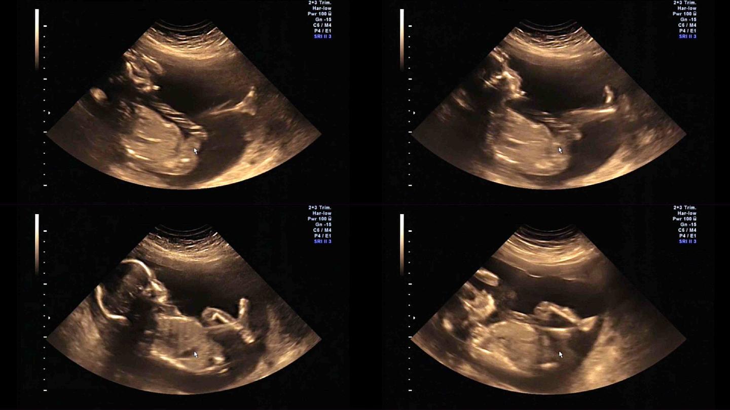 婴儿或胎儿21周时的超声波检查