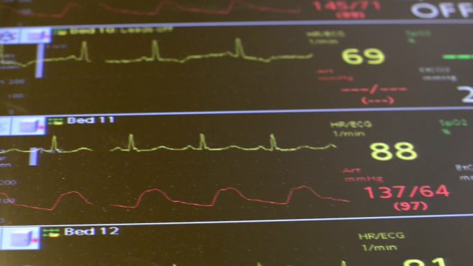 急诊室心脏监护仪显示几个病人的参数