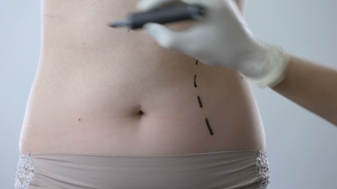 外科医生在腹部画上记号为做吸脂手术做准备