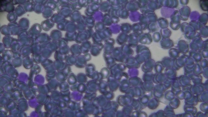急性淋巴细胞白血病ALL-L2血涂片光镜下观察