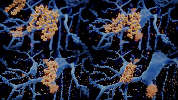 淀粉样β肽聚集成神经元上的淀粉样斑块
