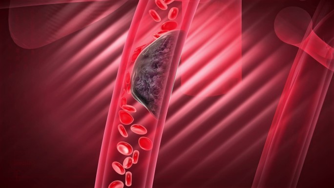 心血管被斑块堵塞心肌细胞就会大面积死亡