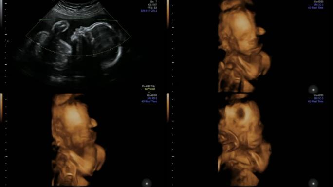 人类胎儿超声检查医学临床保健和医学科学