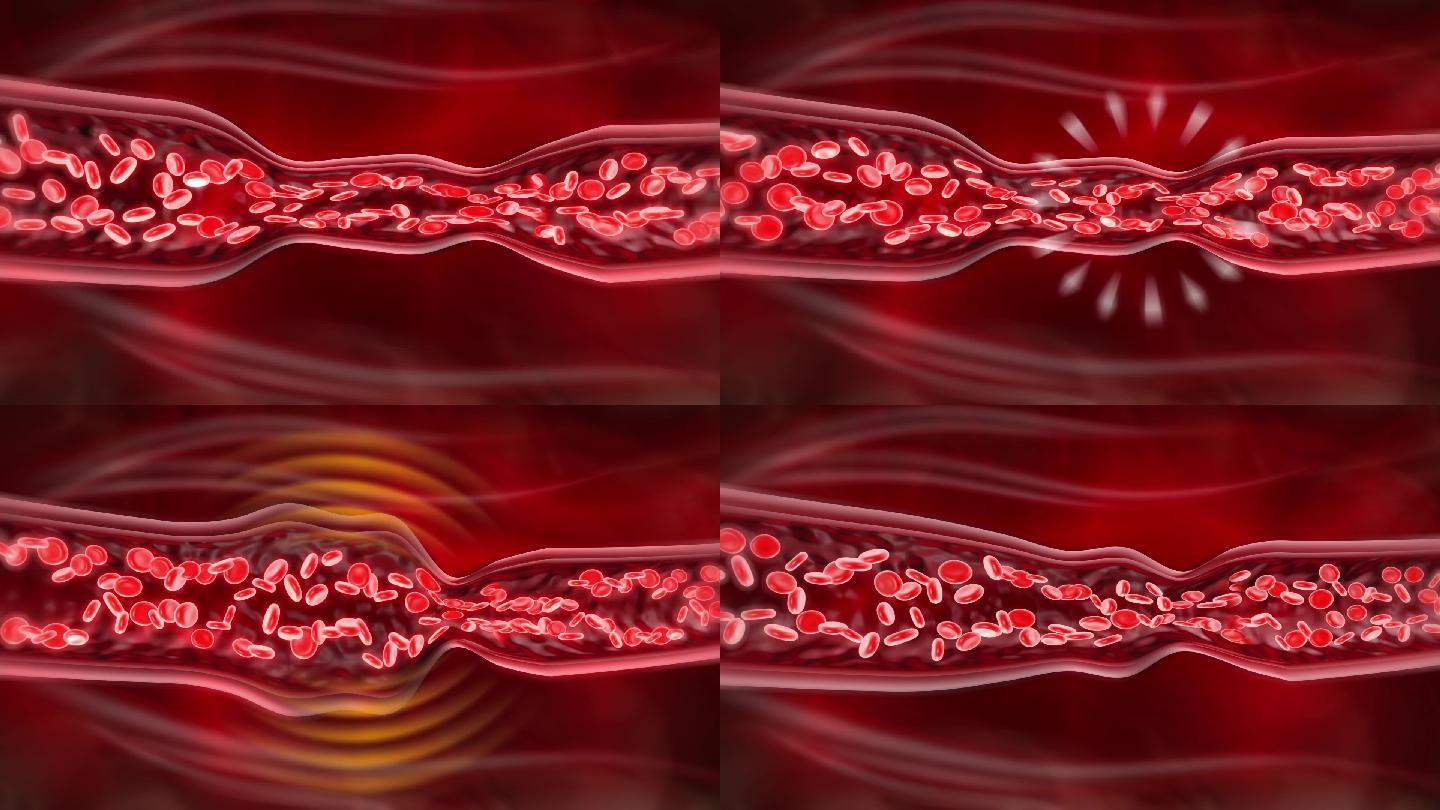 血管痉挛血液淤积收缩处再胀开导致变形发炎