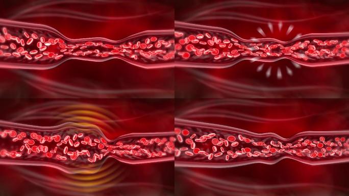 血管痉挛血液淤积收缩处再胀开导致变形发炎
