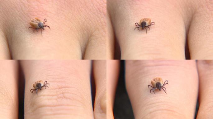 人类皮肤上的蜱虫动物世界蜘蛛网大自然