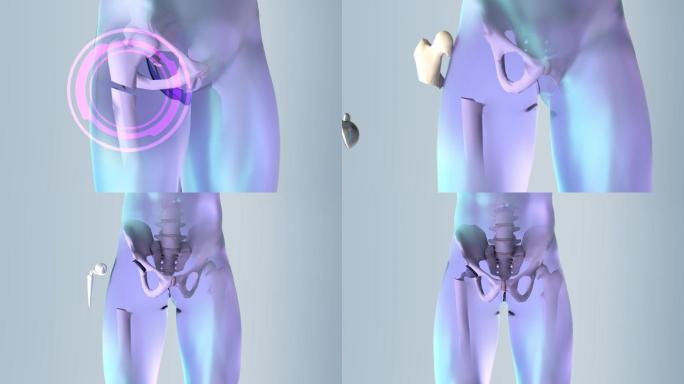 髋关节植入骨盆骨创新医学医疗保健