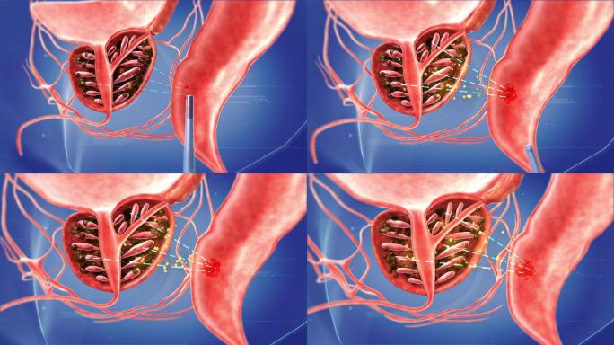 前列腺直肠给药