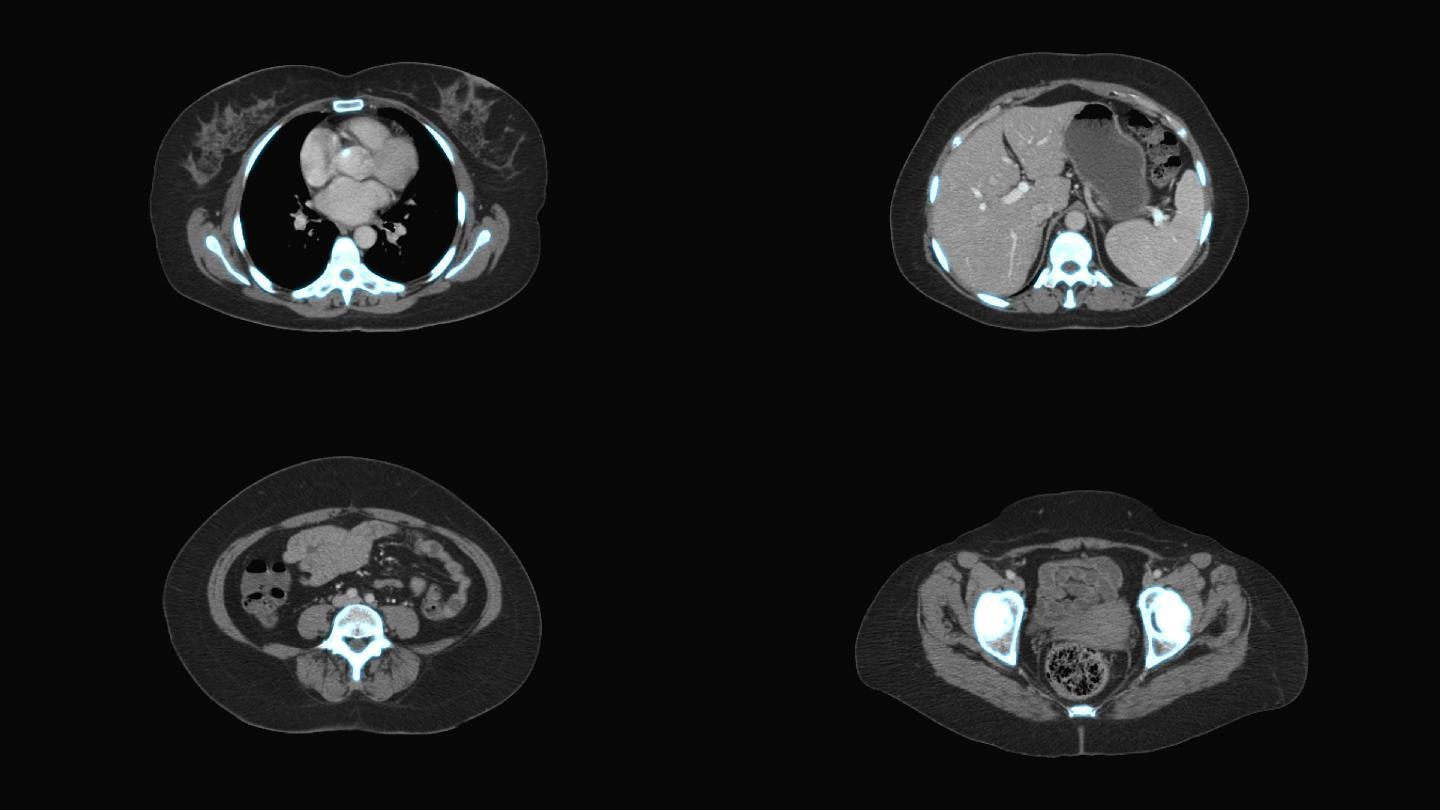 CAT扫描仪图像肿瘤医疗诊所脑肿瘤