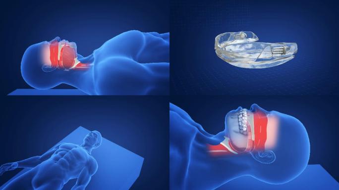 人体打鼾三维医学原理动画
