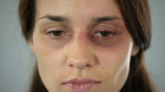 脸上有瘀伤的女人伤心地看着摄像机