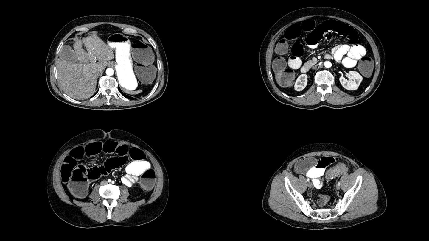 腹部CT扫描医院检查
