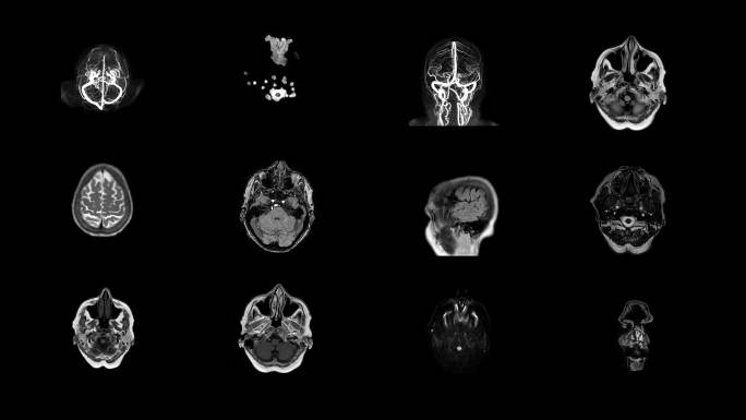 人脑磁共振扫描