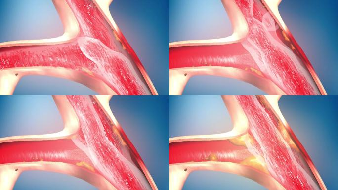 血管血液粥样动脉硬化