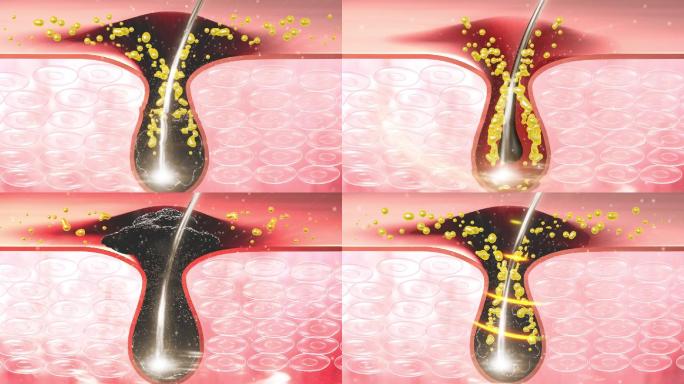 疏通毛囊堵塞垃圾