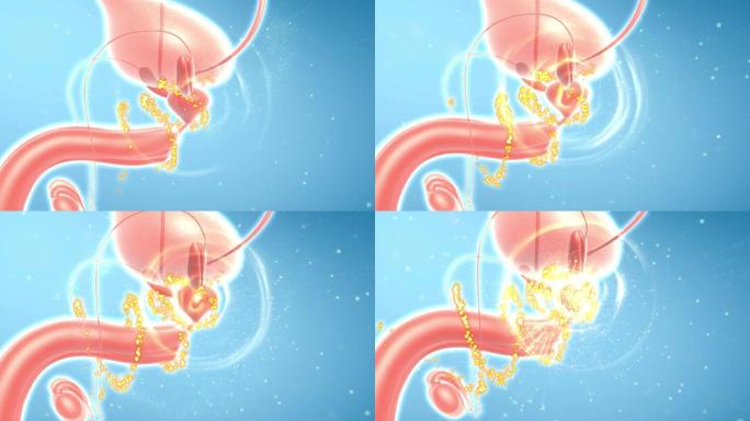 疏通前列腺恢复性功能障碍