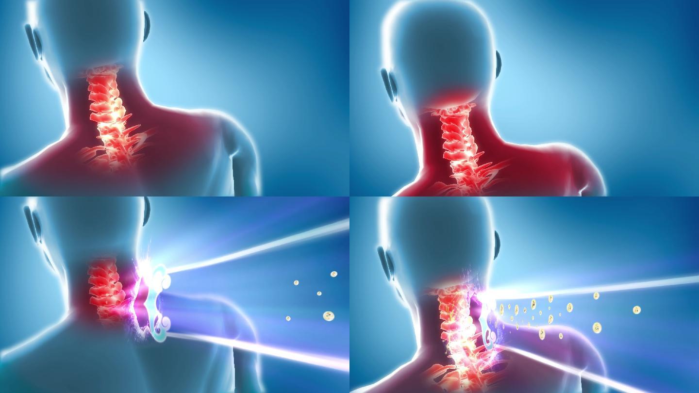 Cervical Spondylosis Clipart PNG, Vector, PSD, and Clipart With ...