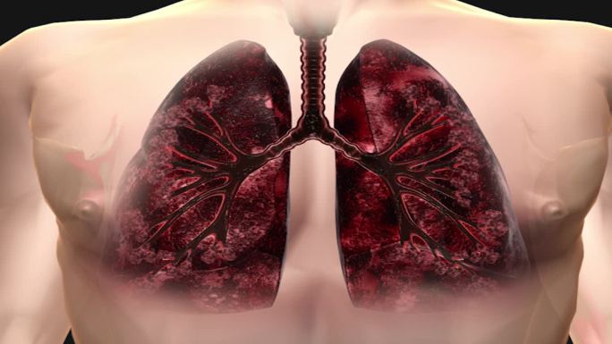 肺结核肺部感染 肺炎 呼吸疾病