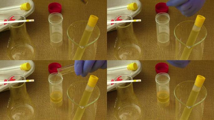 医生手中的尿液分析容器