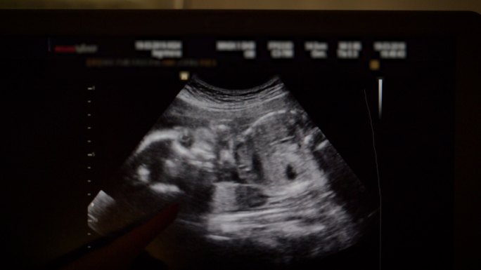 妊娠中期胎儿在子宫内的超声波