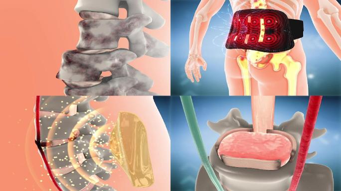 脊柱关节 股骨头 骨头 风湿关节炎 腰椎