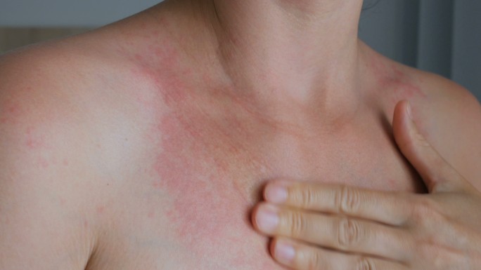 女人用手、脖子搔痒。颈部红斑、过敏