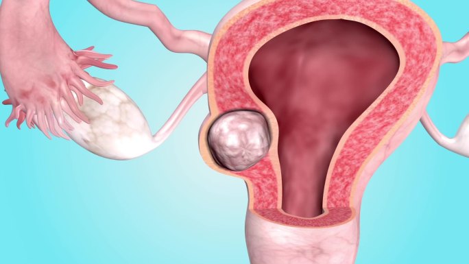女性子宫肌瘤