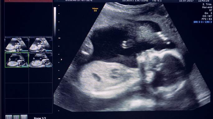 B超影像彩超检测孕检体检孕妇孕期