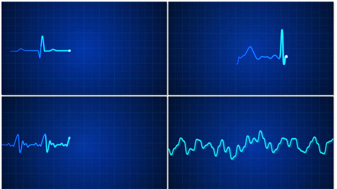 心率心电图波动视频