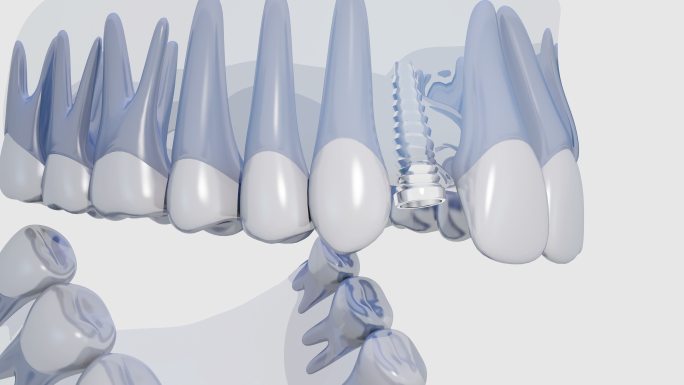 牙种植三维展示医疗牙科种牙操作原理