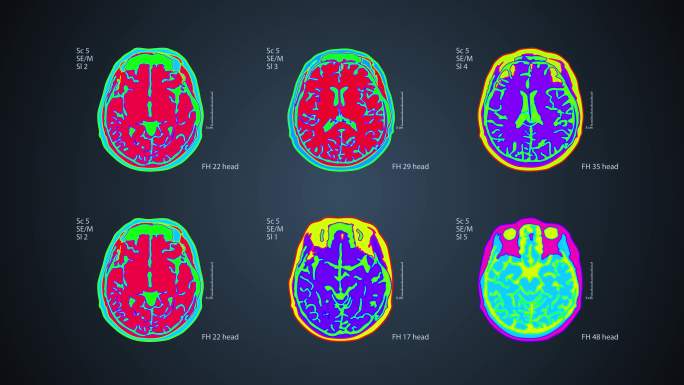 脑部MRT扫描核磁共振成像头部检查多光谱