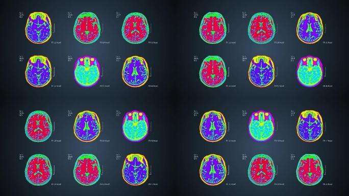 脑部MRT扫描核磁共振成像头部检查多光谱