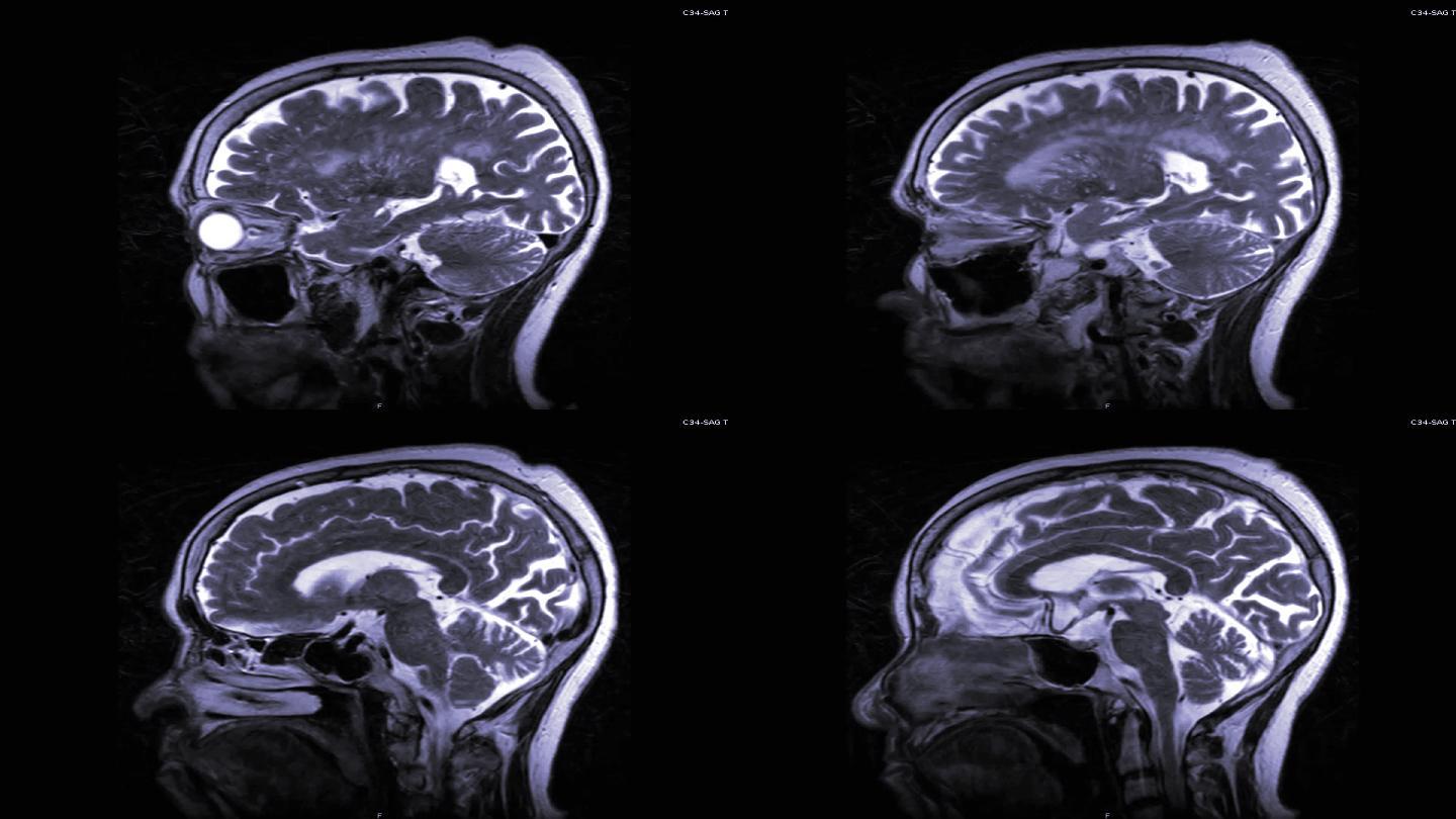大脑磁共振成像。