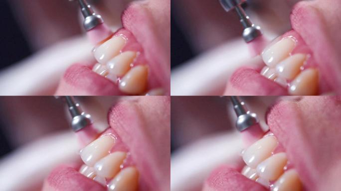 牙科诊所的牙齿抛光