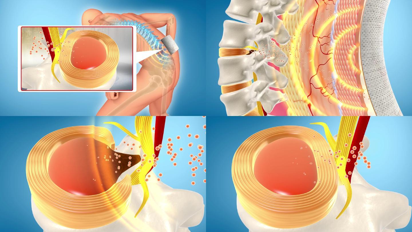 修复受损腰椎纤维环