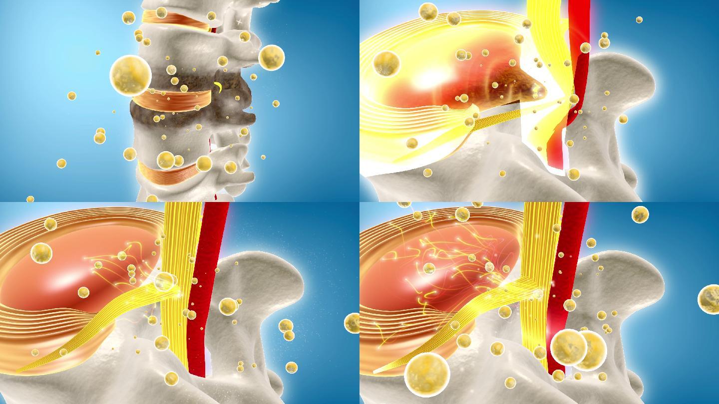 腰椎病修復纤维环弹性