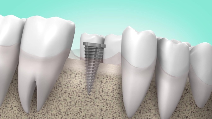 种植牙过程