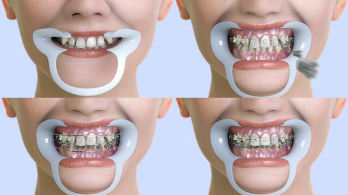 牙套是如何工作的修牙牙医整齐的牙牙线