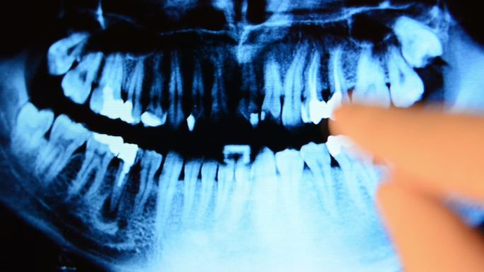 牙科x光片