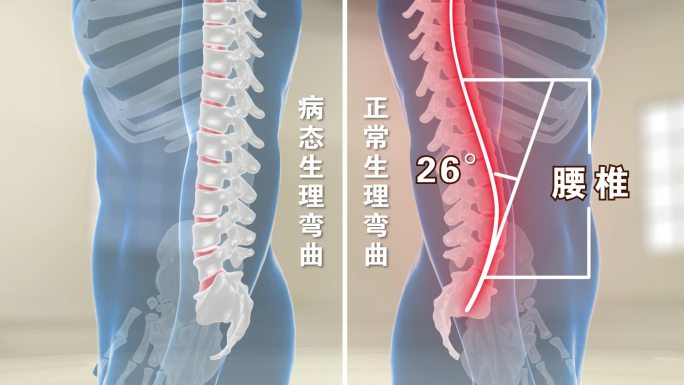 腰突压迫神经视频素材