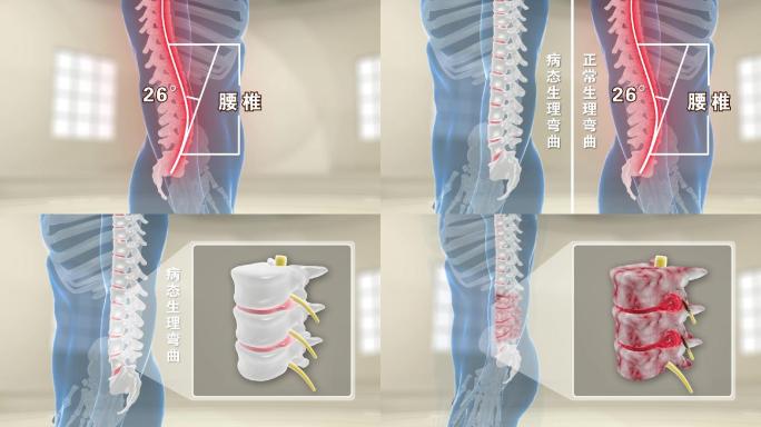 腰突压迫神经视频素材