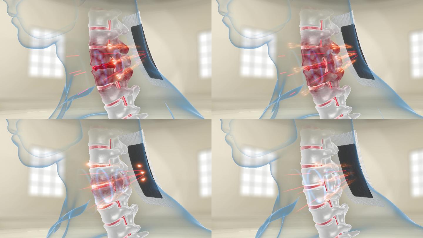 颈椎突出磁疗治颈椎病