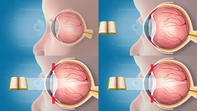 近视眼形成原理