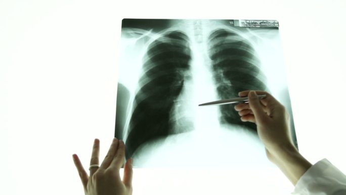 医生在肺部x光图像上用手指点的特写镜头