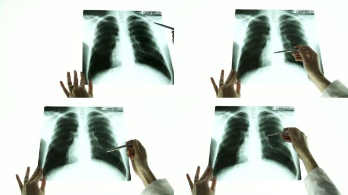 医生在肺部x光图像上用手指点的特写镜头