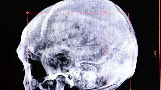 CT扫描机颅骨